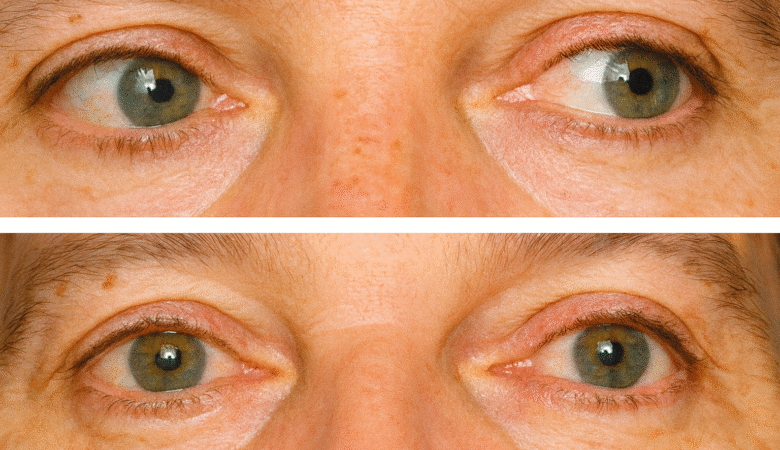 Cirugía de Estrabismo